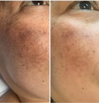 Clearer Skin: Effective Hyperpigmentation Treatments - Skinholic