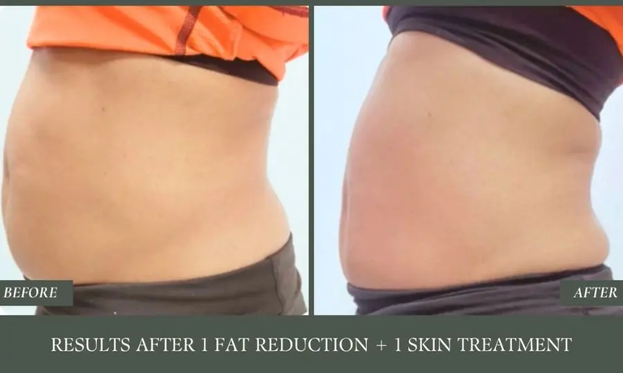 Before and after: results after 1 fat reduction + 1 skin treatment.