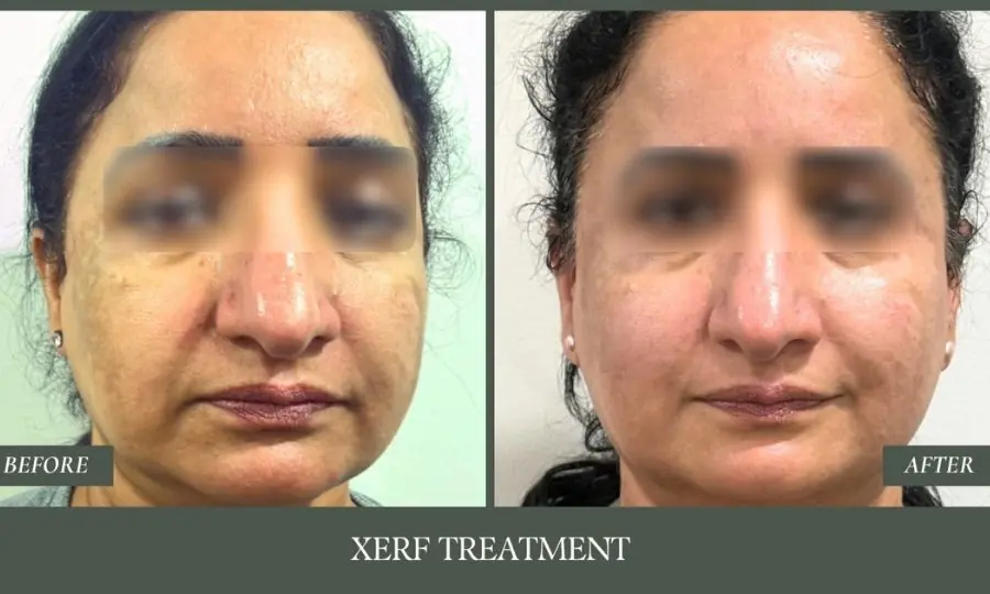 Before and after comparison: xerf treatment.