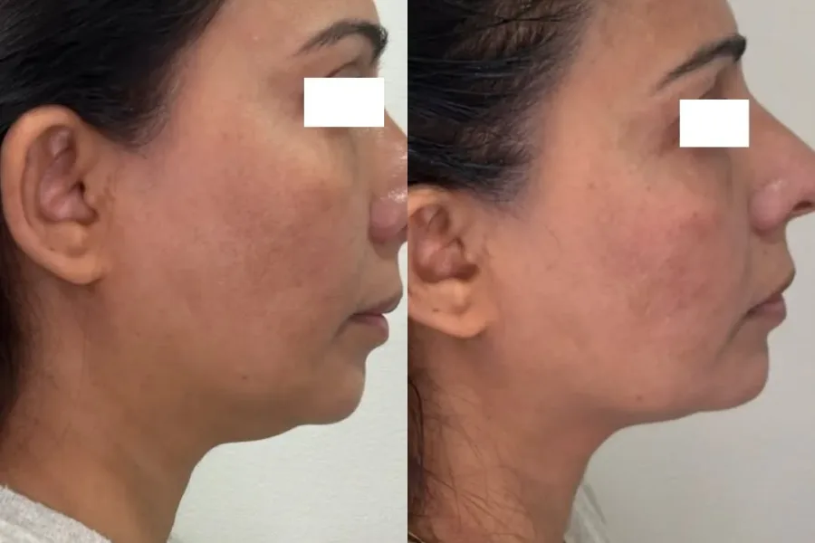 Before (left) and after (right) of a XERF non-surgical facelift: a firmer jawline and smoother neck.