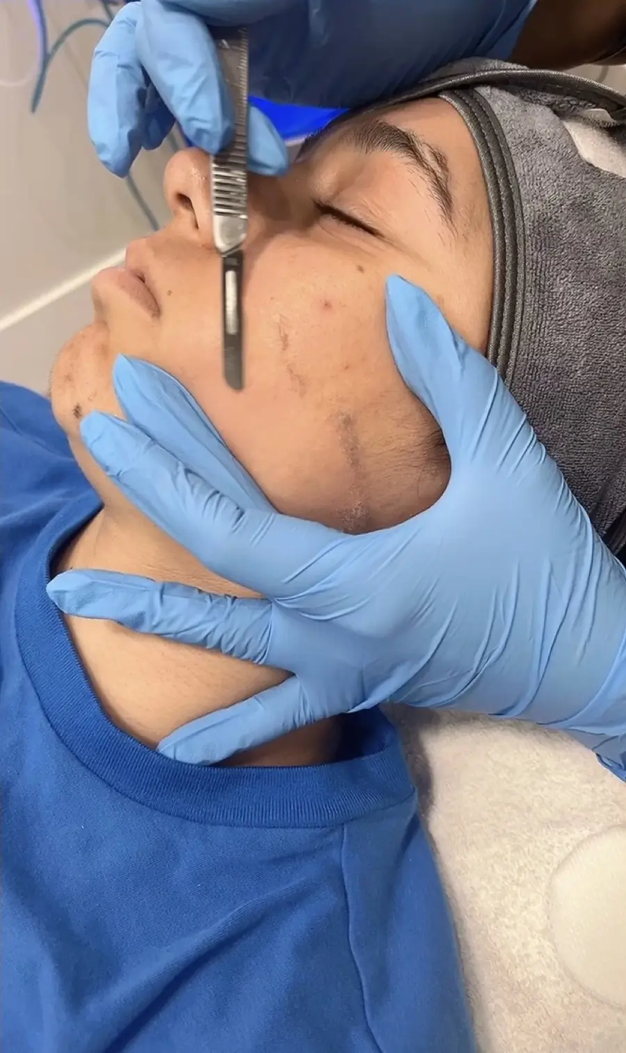 Acne facial or anti-ageing facial?