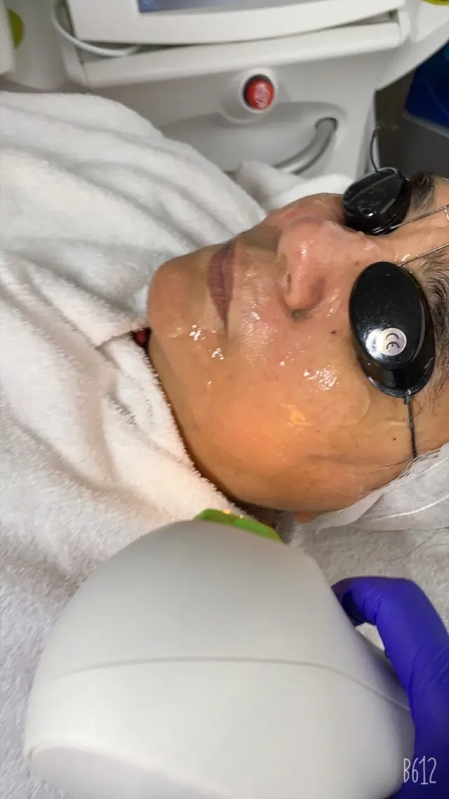 Close view of an IPL photofacial with protective eyewear and cooling gel.