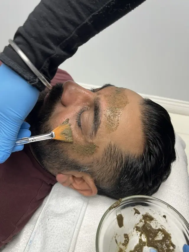 Peels in progress at Skinholic Aesthetics & Laser in Surrey.