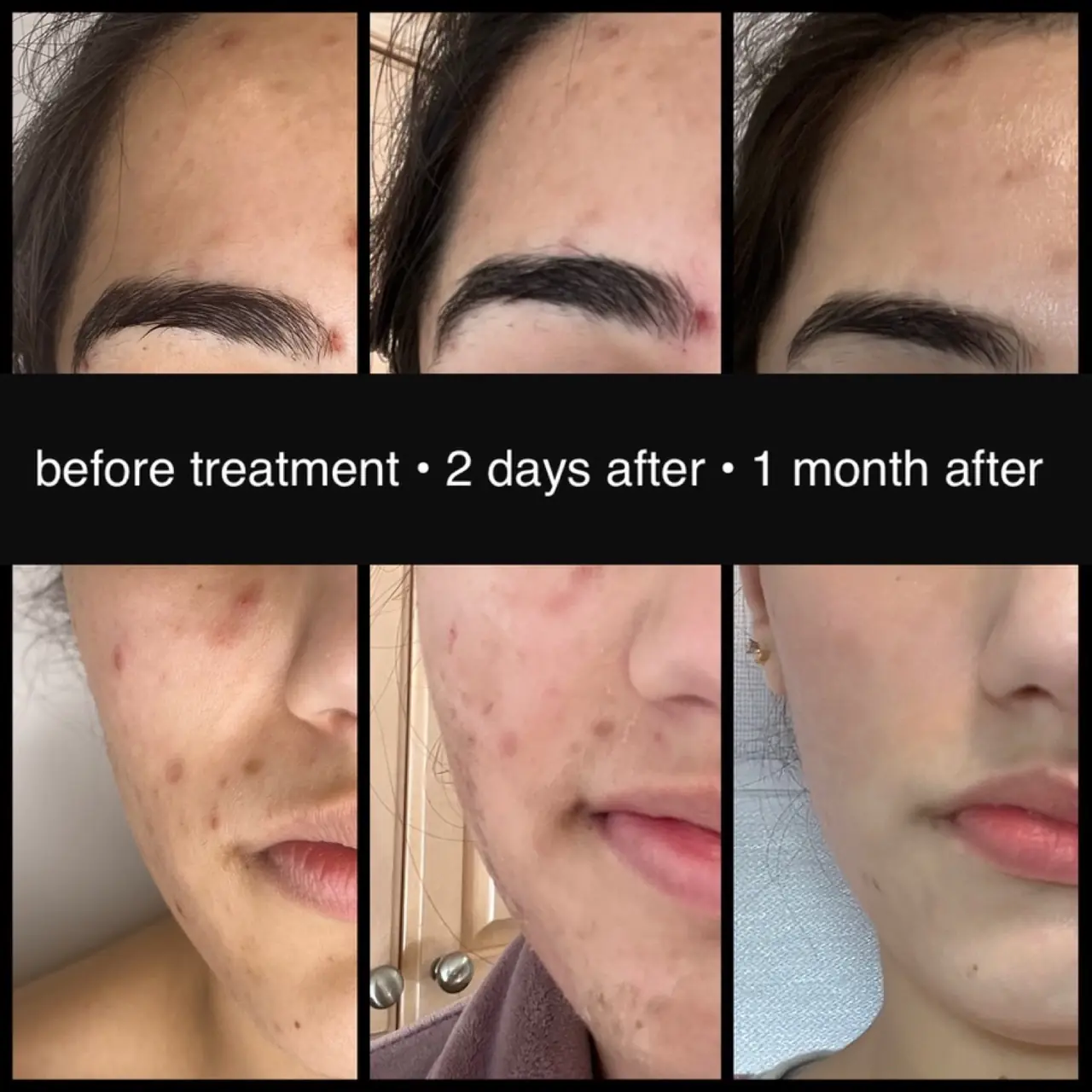 A client's skin before treatment, two days after, and one month after a course of peels.