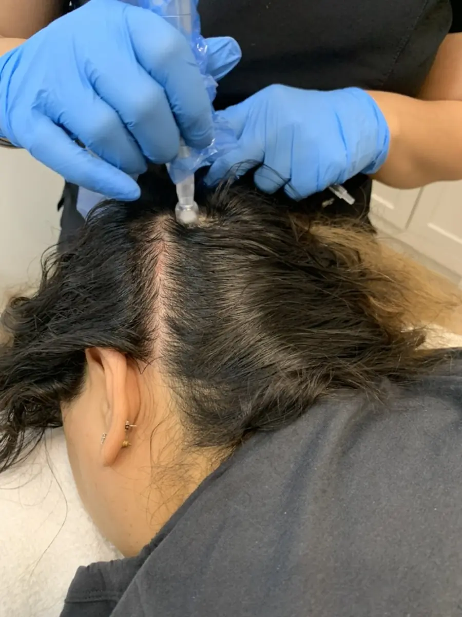 Scalp treatments in progress at Skinholic Aesthetics & Laser in Surrey.