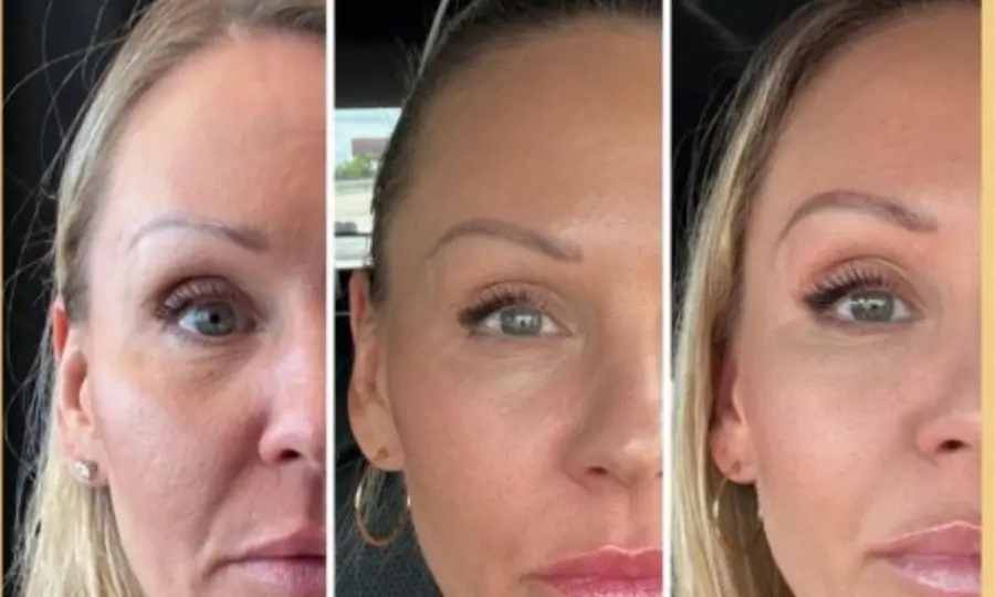 XERF Skin Tightening & Jawline Contouring in Surrey