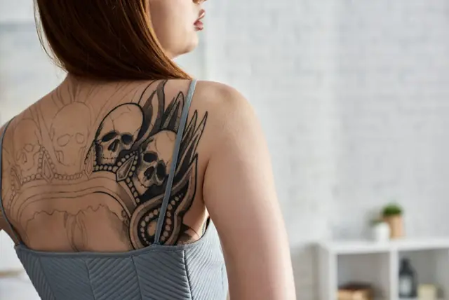 What are the options for removing a tattoo?