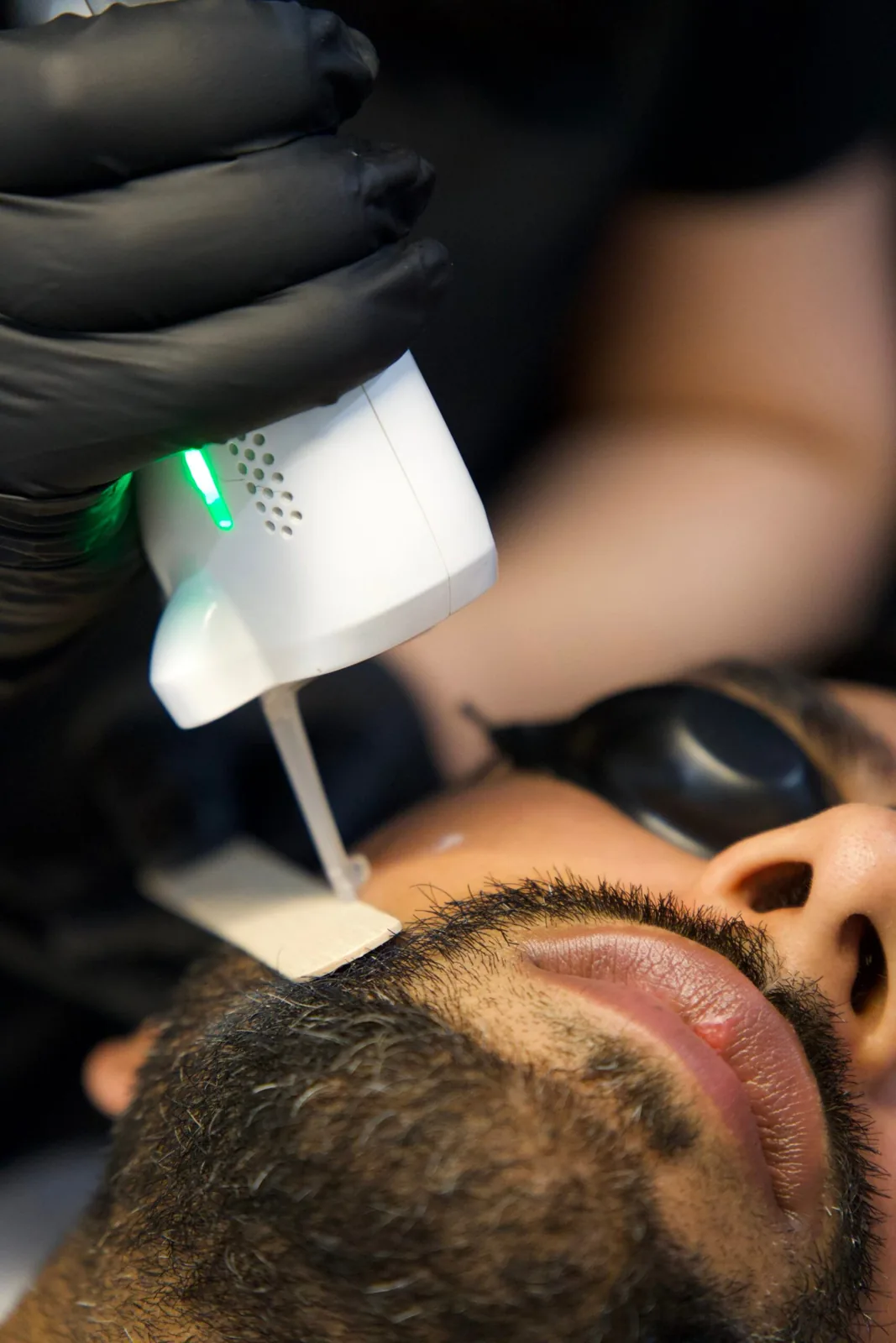 Nd:YAG & Alexandrite LHR at Skinholic Aesthetics & Laser in Surrey.