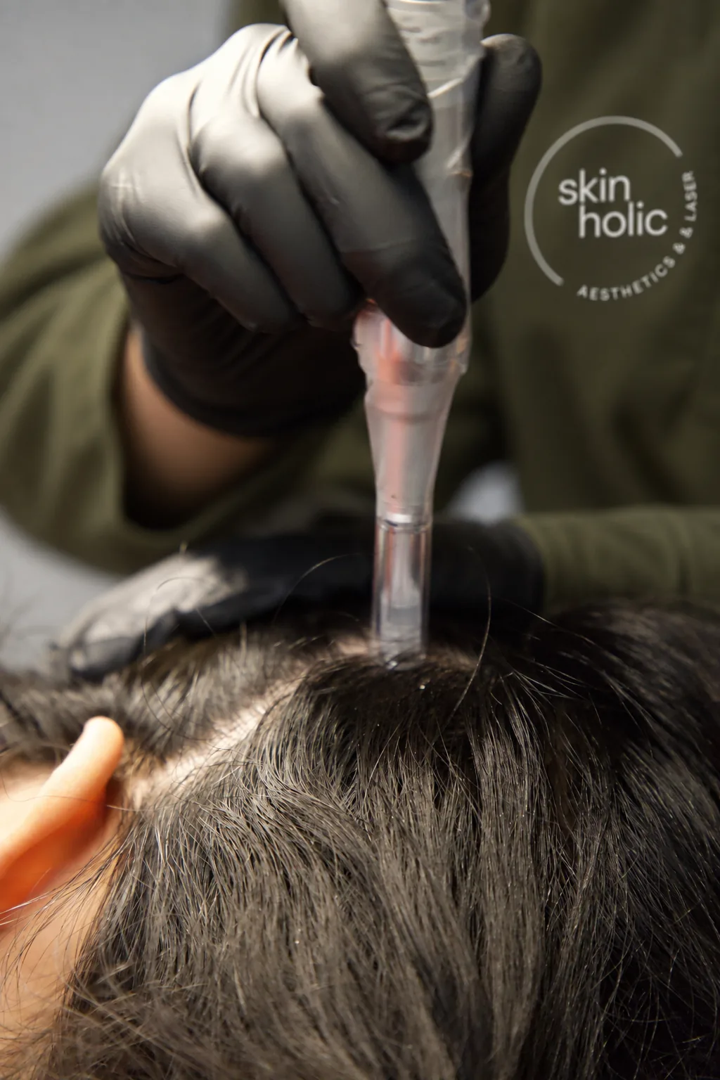 Gloved hand holds a microneedling pen upright against the scalp in dark hair, a close-up DERIVE hair wellness step