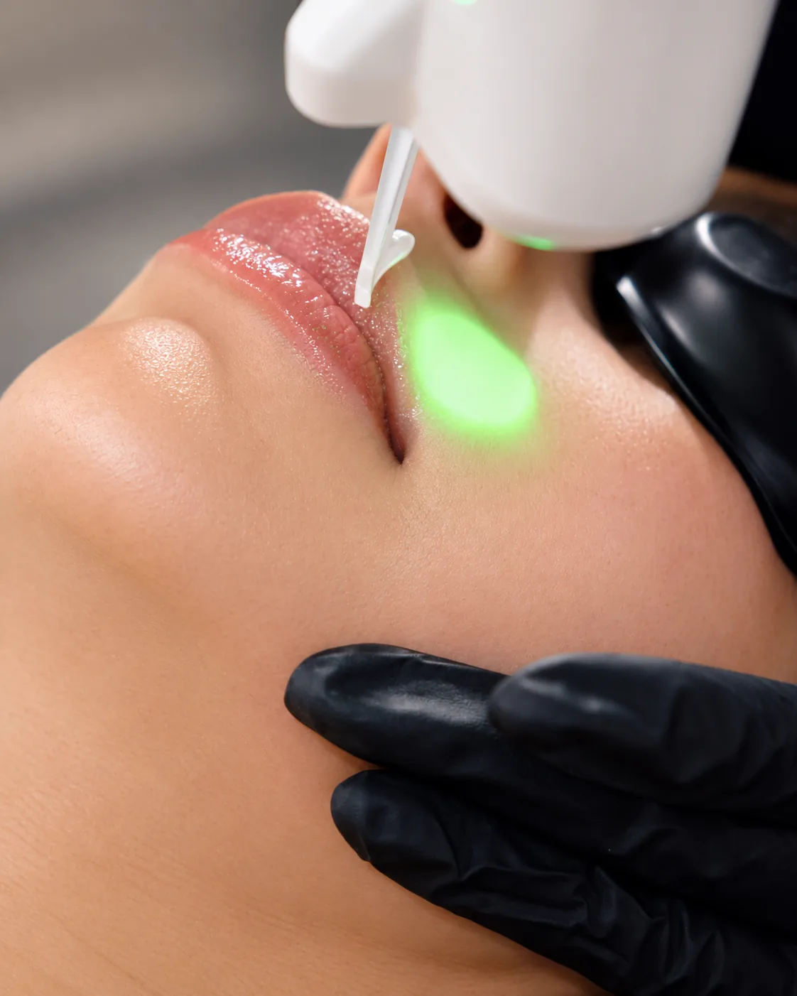 Nd:YAG laser handpiece projecting a green light spot between a woman's nose and upper lip as a gloved hand steadies her jaw