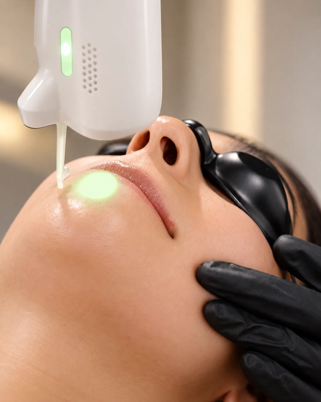 Nd:YAG laser handpiece casting a green light spot beside a woman's lips while black shields cover her eyes