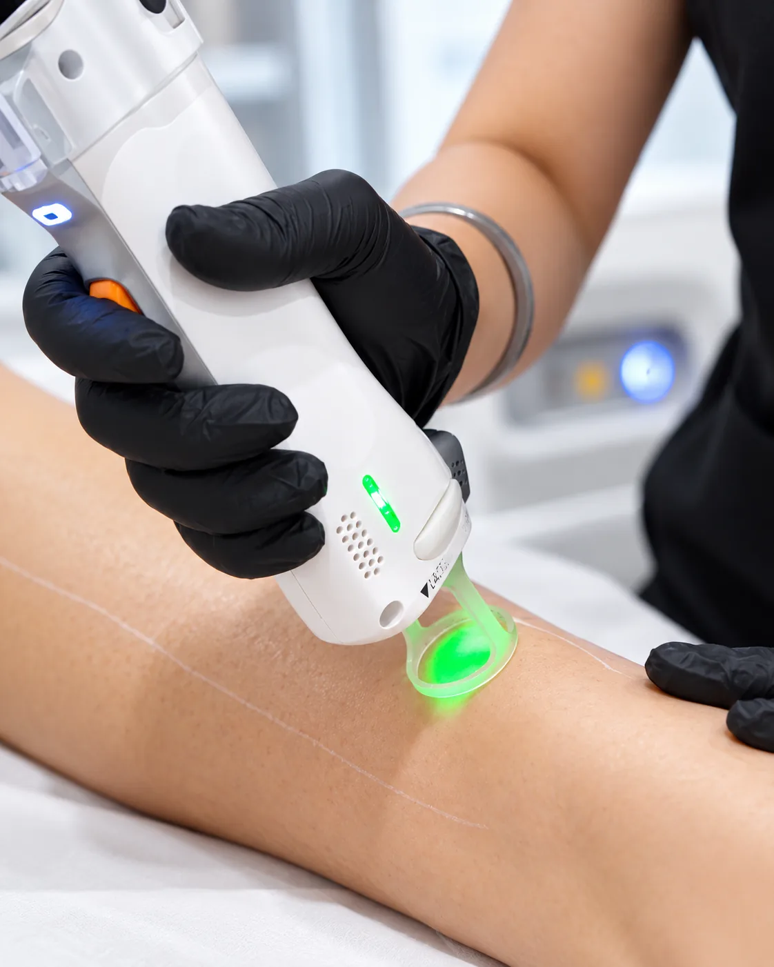 Black-gloved hand presses a white Nd:YAG laser handpiece with a glowing green tip onto skin marked with a guide line