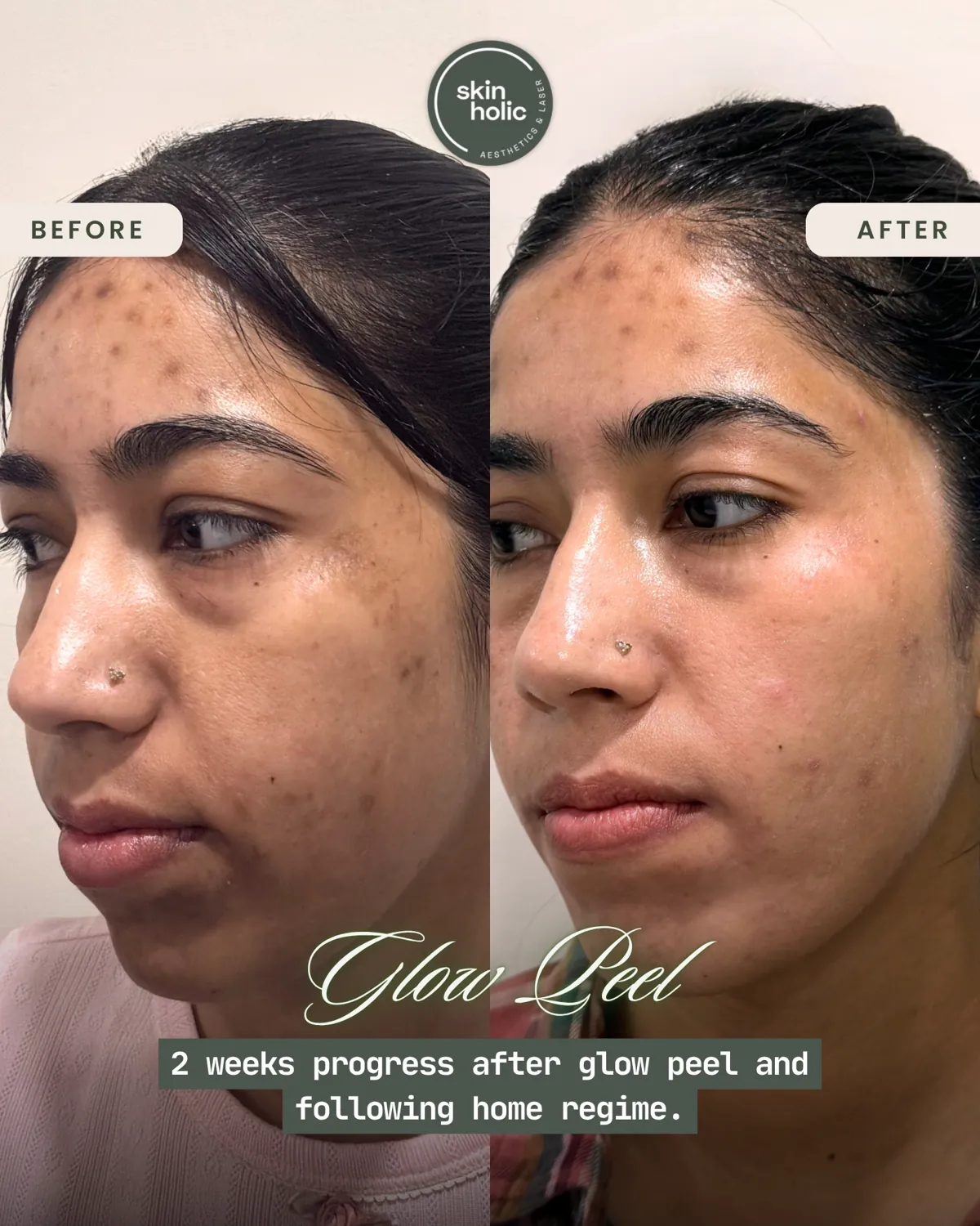 Before and after: Glow peel.