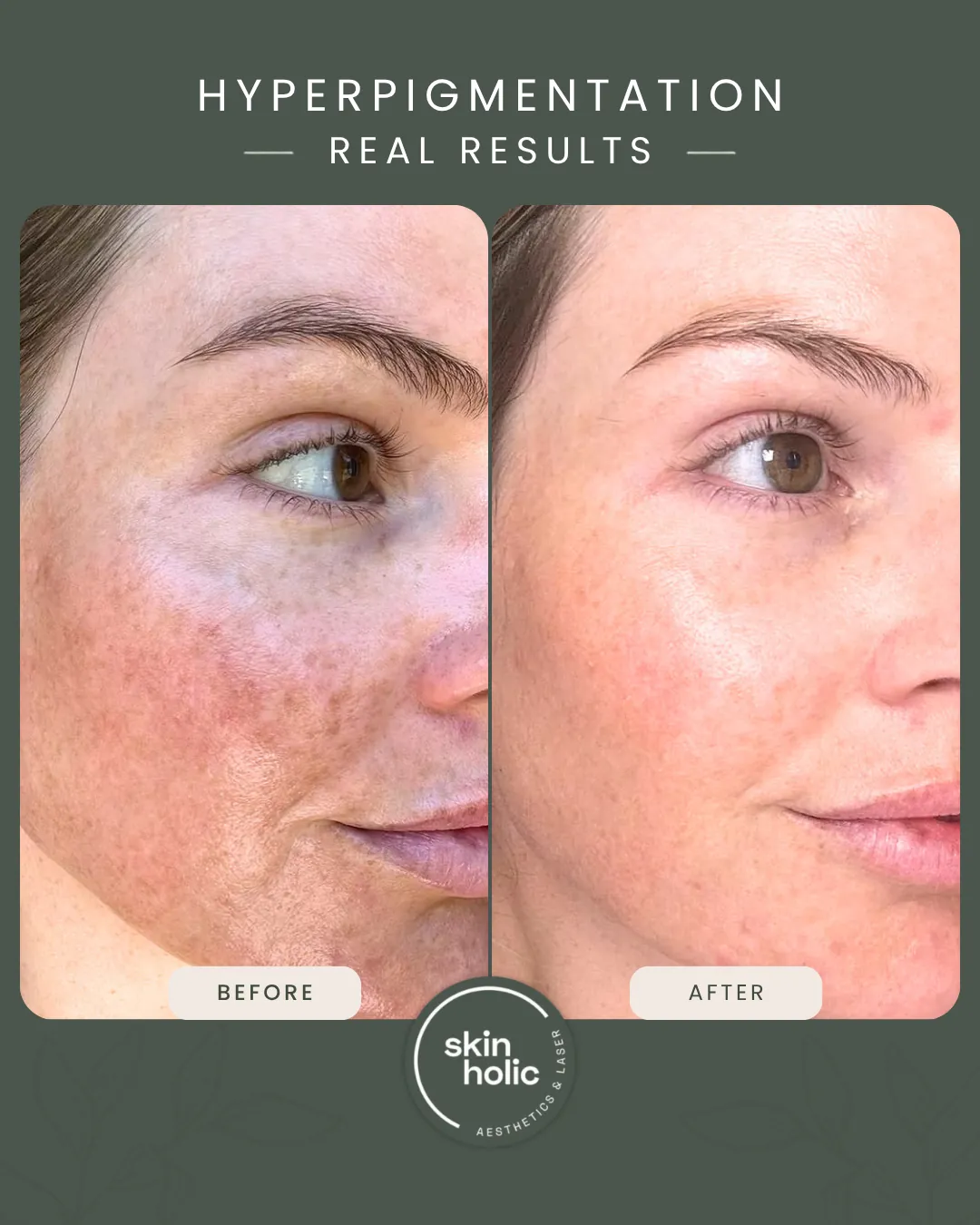 Before and after: Hyperpigmentation.