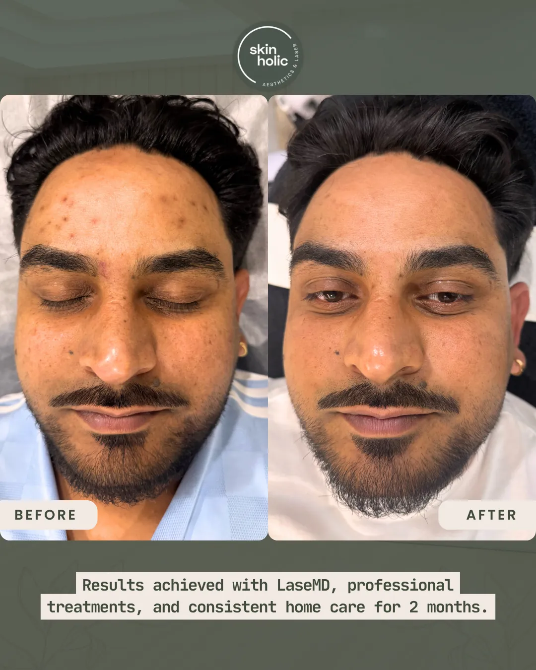 Before and after: LaseMD skin resurfacing.