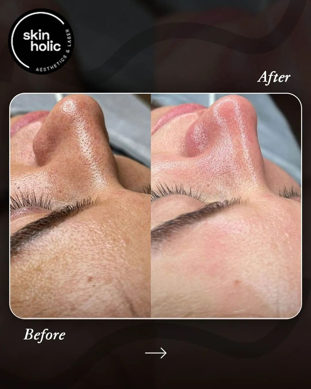 Before and after: Laser carbon facial.