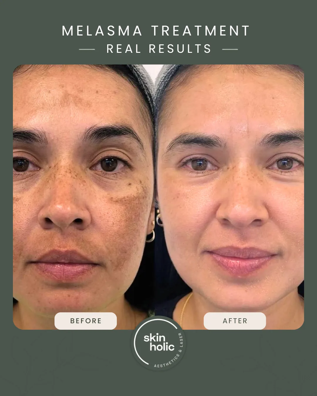 Before and after: Melasma, customised treatment plan.