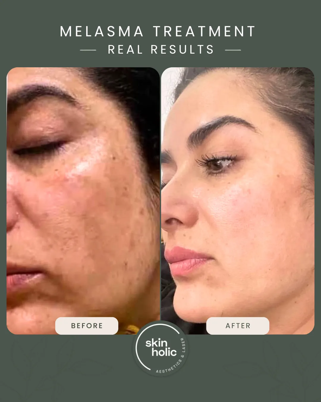Before and after: Melasma, customised treatment plan.