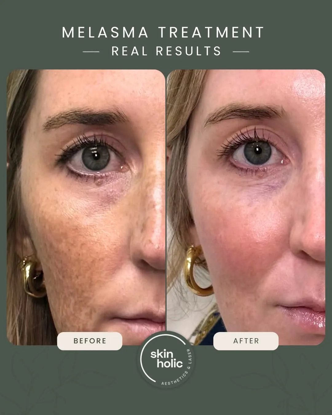 Before and after: Melasma, customised treatment plan.
