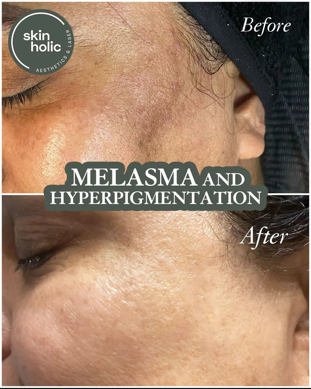 Before and after: Melasma, customised treatment plan.