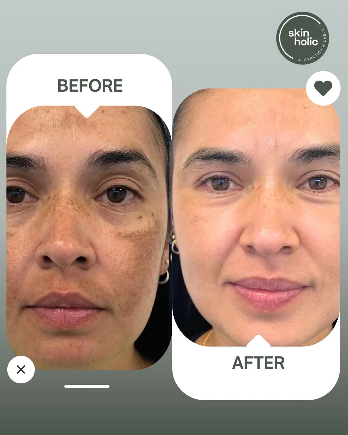 Before and after: Pigmentation.