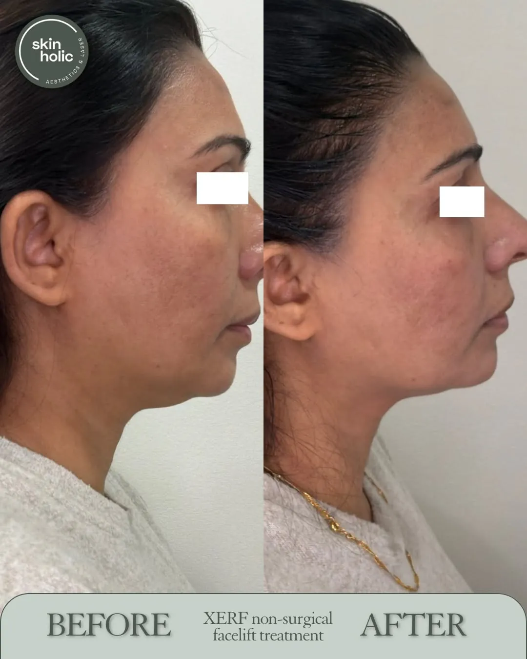 Before and after: XERF non-surgical facelift.