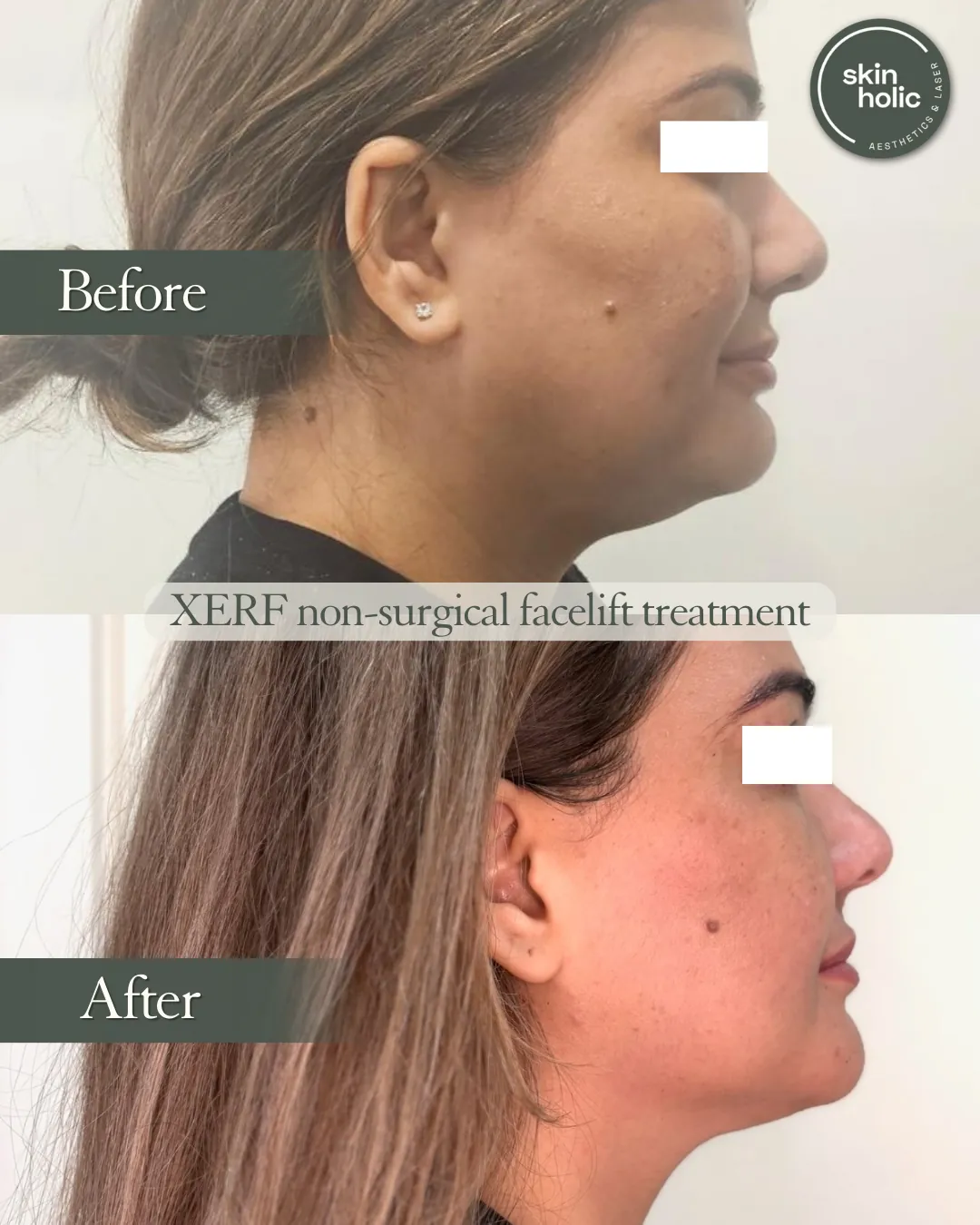 Before and after: XERF non-surgical facelift.