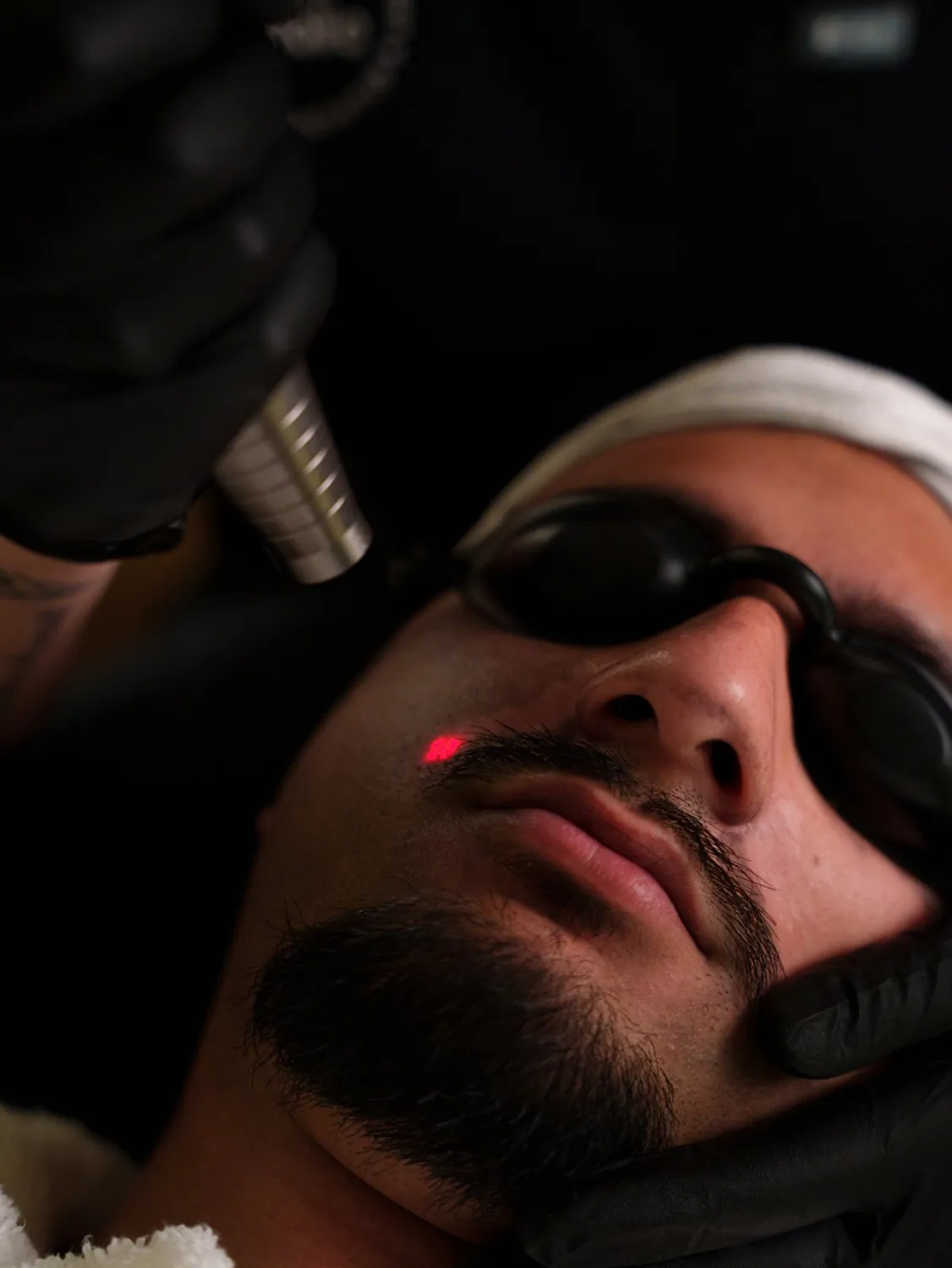 Laser carbon facial at Skinholic Aesthetics & Laser, Surrey.