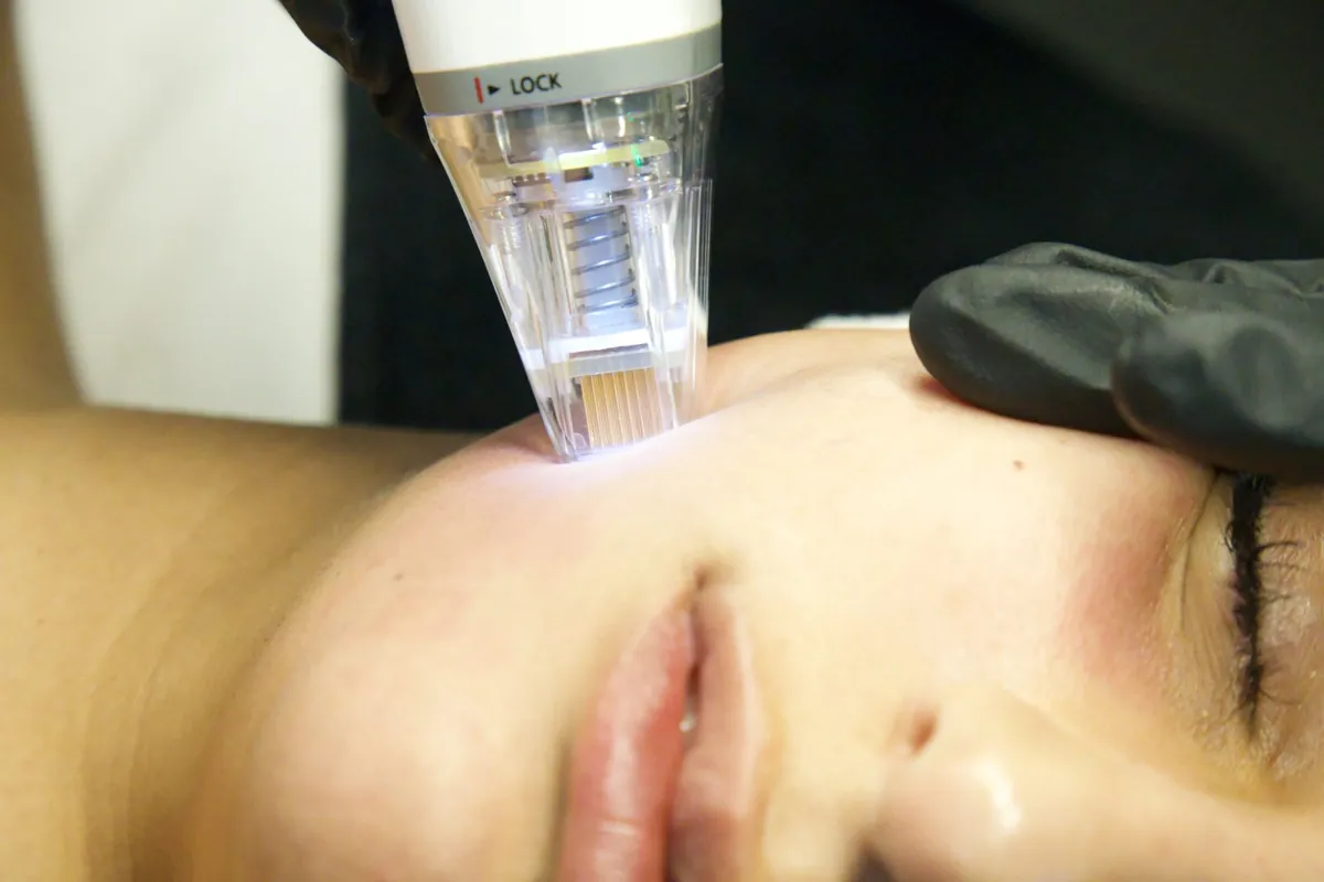 Potenza, up close at Skinholic Aesthetics & Laser, Surrey.