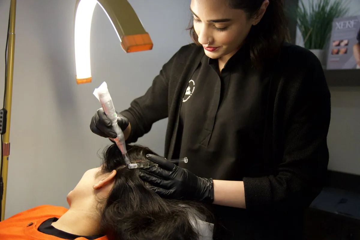 Scalp microneedling at Skinholic Aesthetics & Laser, Surrey.