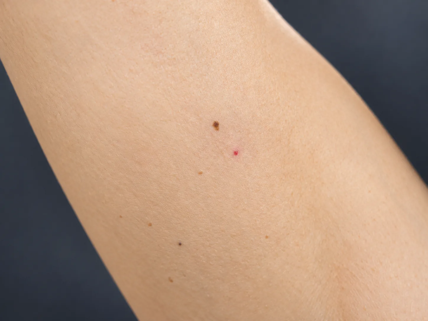 Close-up of smooth inner arm skin with a small brown mole and a tiny red dot, shown alongside skin tag removal