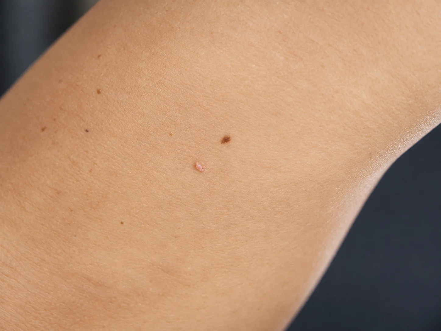 Close-up of a small flesh-pink skin tag beside a brown mole on the inner arm, a common reason for skin tag removal
