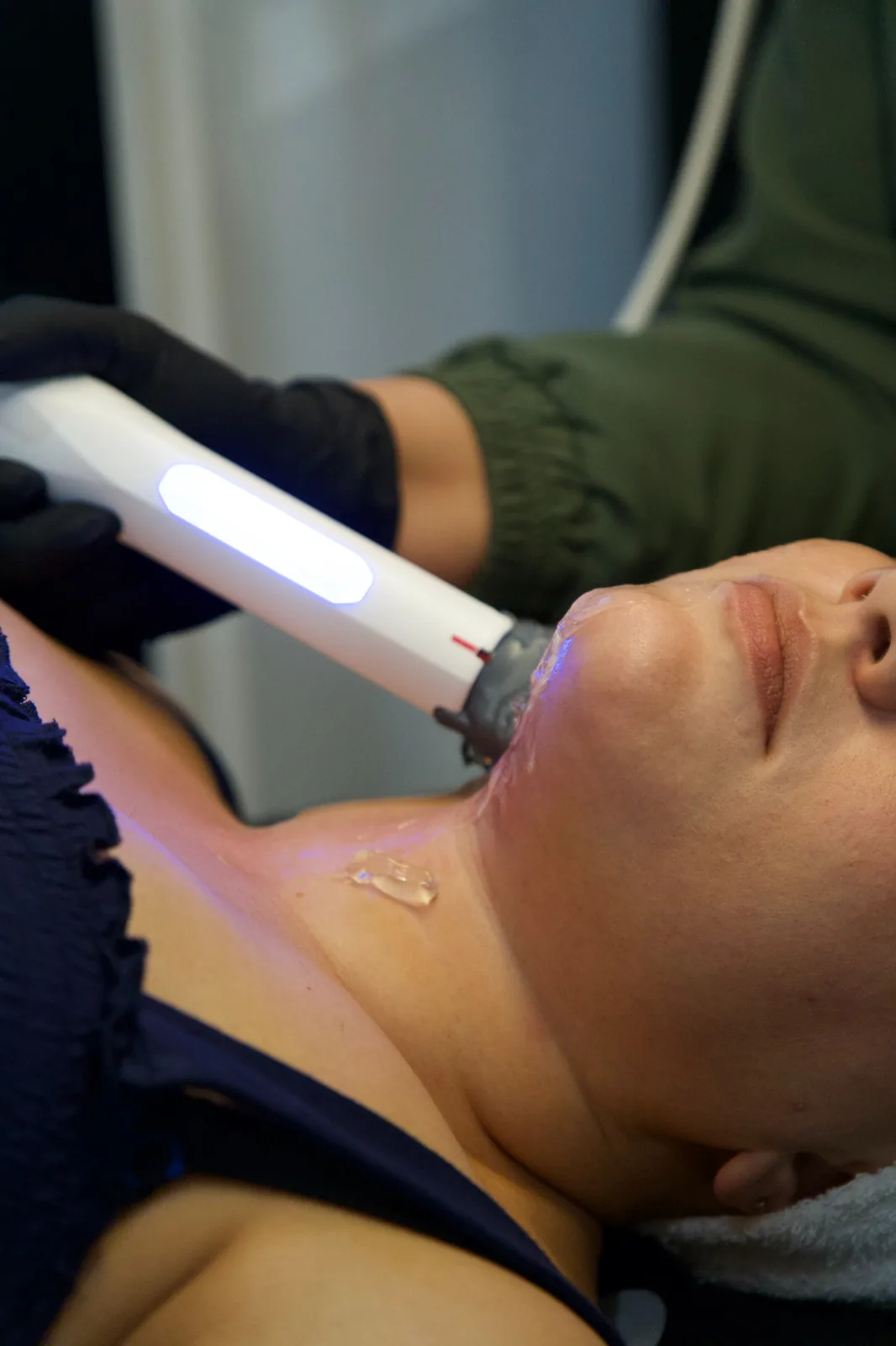 Skin tightening treatment on jawline and neck