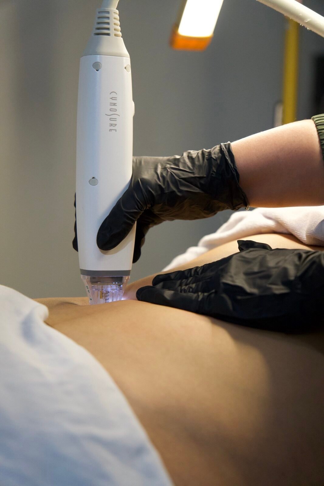 Closeup of stretch mark reduction treatment device on skin
