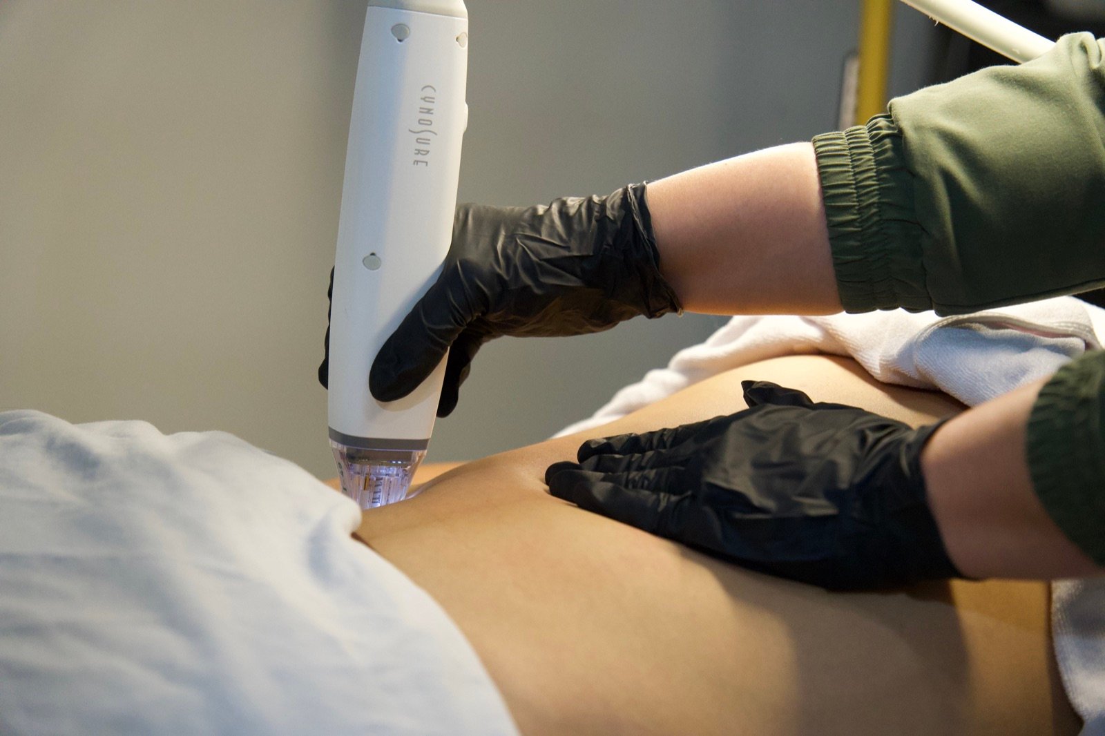 Stretch mark reduction device treatment with practitioner hands