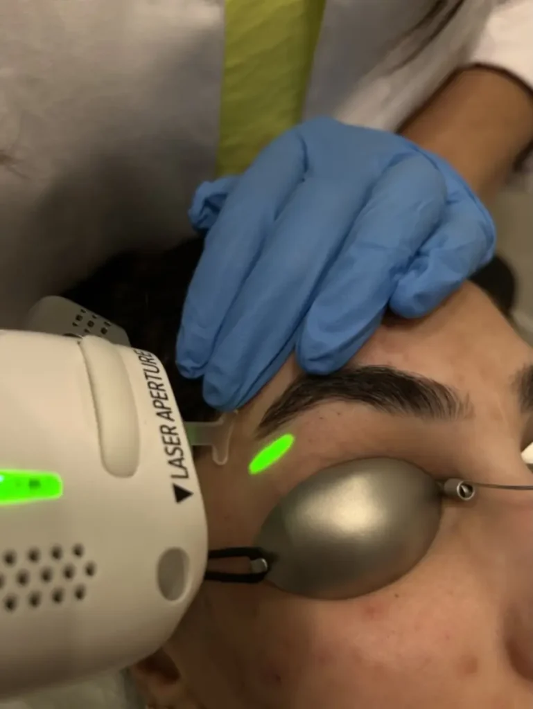 XERF Non Surgical Facelift at Skinholic Surrey